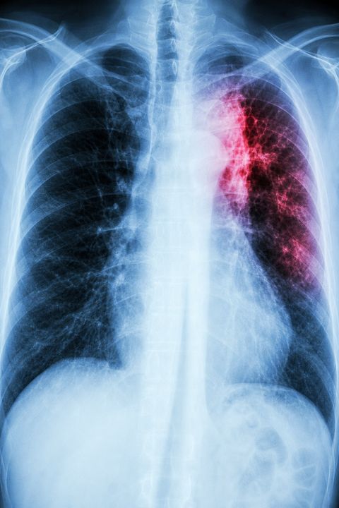 India rejects United States firm patent application for six month tuberculosis treatment